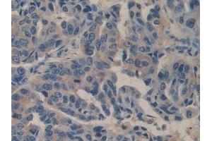 Detection of BGN in Human Breast cancer Tissue using Polyclonal Antibody to Biglycan (BGN)