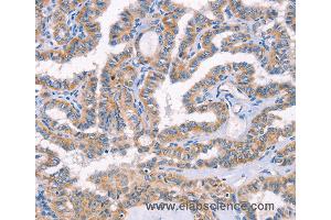 Immunohistochemistry of Human lung cancer using AP1B1 Polyclonal Antibody at dilution of 1:70 (AP1B1 anticorps)