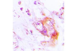 Immunohistochemical analysis of PKR (pT451) staining in human lung cancer formalin fixed paraffin embedded tissue section. (EIF2AK2 anticorps  (C-Term, pSer451))