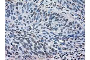 Immunohistochemical staining of paraffin-embedded Adenocarcinoma of breast tissue using anti-MAPK1 mouse monoclonal antibody. (ERK2 anticorps)