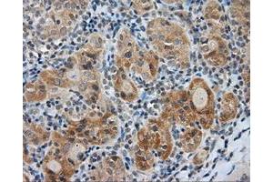 Immunohistochemical staining of paraffin-embedded Adenocarcinoma of colon tissue using anti-LIPG mouse monoclonal antibody. (LIPG anticorps)