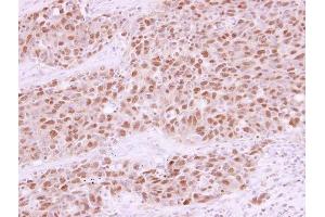 IHC-P Image RAD21 antibody detects RAD21 protein at nucleus in human lung papillary adenocarcinoma by immunohistochemical analysis.