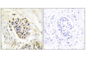 Immunohistochemistry analysis of paraffin-embedded human breast carcinoma tissue using MED1 antibody. (MED1 anticorps  (Internal Region))