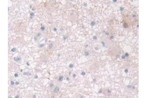 Detection of CRABP2 in Human Glioma Tissue using Polyclonal Antibody to Cellular Retinoic Acid Binding Protein 2 (CRABP2)