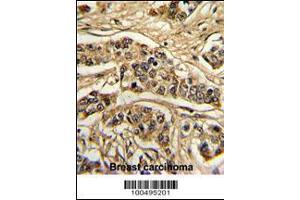 Formalin-fixed and paraffin-embedded human breast carcinoma reacted with NCS1 Antibody , which was peroxidase-conjugated to the secondary antibody, followed by DAB staining.