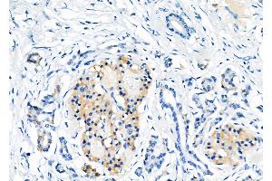 ABIN6257207 and ABIN6275954 at 1/100 staining Human pancreatic cancer by IHC-P. (G Protein-Coupled Receptor 119 anticorps  (Internal Region))