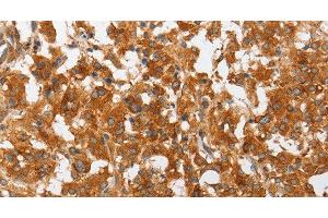 Immunohistochemistry of paraffin-embedded Human thyroid cancer using cPLA2 Polyclonal Antibody at dilution of 1:50 (PLA2G4A anticorps)