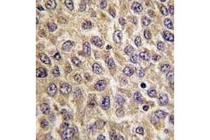 IHC analysis of FFPE human hepatocarcinoma tissue stained with ILK antibody (ILK anticorps  (AA 225-253))
