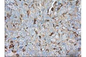Immunohistochemical staining of paraffin-embedded Adenocarcinoma of colon tissue using anti-ALDH3A1 mouse monoclonal antibody. (ALDH3A1 anticorps)
