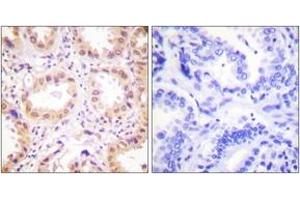 Immunohistochemistry analysis of paraffin-embedded human lung carcinoma tissue, using NEDD8 Antibody. (NEDD8 anticorps  (AA 10-59))