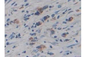 Detection of CYP21A2 in Human Stomach cancer Tissue using Polyclonal Antibody to Cytochrome P450 Family 21 Subfamily A Member 2 (CYP21A2)