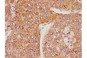 IHC image of ABIN7164243 diluted at 1:100 and staining in paraffin-embedded human liver cancer performed on a Leica BondTM system. (PSG9 anticorps  (AA 241-426))