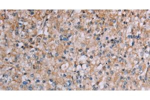 Immunohistochemistry of paraffin-embedded Human prostate cancer tissue using PLXNA4 Polyclonal Antibody at dilution 1:50 (Plexin A4 anticorps)