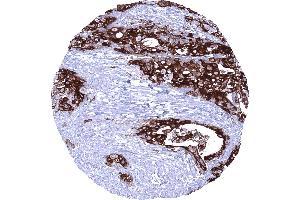 Muscle invasive urothelial carcinoma of the urinary bladder showing a strong Upk1b immunostaining of tumor cells (Uroplakin 1B anticorps  (AA 109-229))