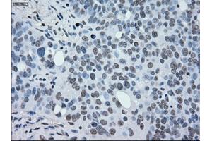 Immunohistochemical staining of paraffin-embedded Adenocarcinoma of breast tissue using anti-MAP2K2 mouse monoclonal antibody. (MEK2 anticorps)