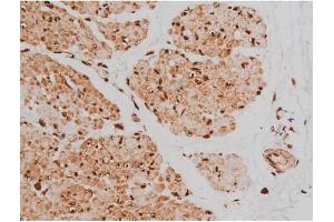 ABIN6267363 at 1/200 staining Human bladder cancer tissue sections by IHC-P.