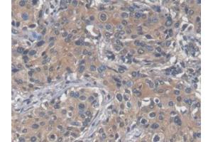 DAB staining on IHC-P; Samples: Human Prostate cancer Tissue (SAA anticorps  (AA 19-122))