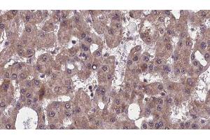 ABIN6277524 at 1/100 staining Human liver cancer tissue by IHC-P. (SLC4A4 anticorps  (C-Term))