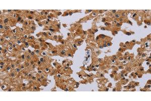 Immunohistochemistry of paraffin-embedded Human prostate cancer tissue using IFRD1 Polyclonal Antibody at dilution 1:40 (IFRD1 anticorps)