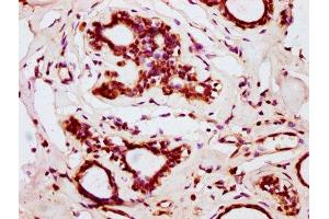 IHC image of ABIN7145662 diluted at 1:200 and staining in paraffin-embedded human breast cancer performed on a Leica BondTM system.