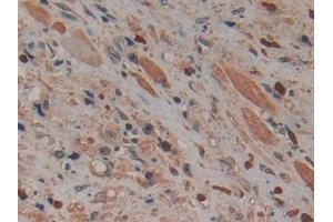 Detection of MCM5 in Human Prostate cancer Tissue using Polyclonal Antibody to Minichromosome Maintenance Deficient 5 (MCM5)