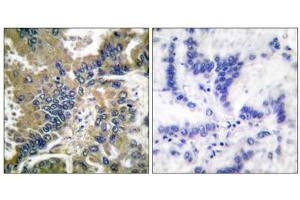 Immunohistochemical analysis of paraffin-embedded human lung carcinoma tissue, using Caspase 1 (Cleaved-Asp210) antibody (ABIN5978453). (Caspase 1 anticorps  (Cleaved-Asp210, Internal Region))