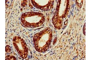 Immunohistochemistry of paraffin-embedded human prostate cancer using ABIN7142946 at dilution of 1:100