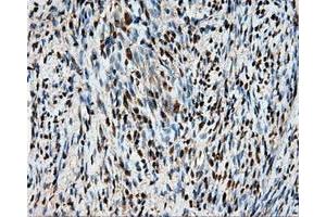 Immunohistochemical staining of paraffin-embedded Adenocarcinoma of ovary tissue using anti-HSPA1A mouse monoclonal antibody. (HSP70 1A anticorps)