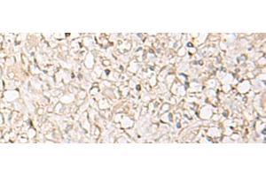 Immunohistochemistry of paraffin-embedded Human ovarian cancer tissue using IGHA1 Polyclonal Antibody at dilution of 1:65(x200) (IGHA1 anticorps)