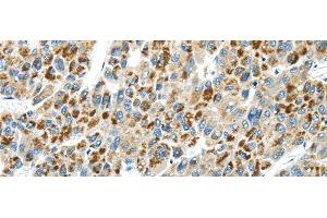 Immunohistochemistry of paraffin-embedded Human liver cancer tissue using THBS2 Polyclonal Antibody at dilution 1:30