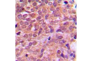 Immunohistochemical analysis of AMPK beta 1 staining in human breast cancer formalin fixed paraffin embedded tissue section.