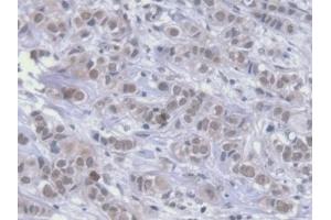 Detection of HSPA1A in Human Breast cancer Tissue using Monoclonal Antibody to Heat Shock 70 kDa Protein 1A (HSPA1A)