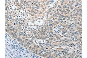 The image on the left is immunohistochemistry of paraffin-embedded Human cervical cancer tissue using ABIN7131538(UCHL5 Antibody) at dilution 1/25, on the right is treated with fusion protein.