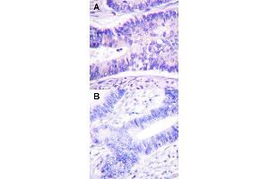 Immunohistochemical staining (Formalin-fixed paraffin-embedded sections) of human colon carcinoma tissue with WASF1 (phospho Y125) polyclonal antibody  under 1:50-1:100 dilution (A) or treated with synthesized peptide (B). (WASF1 anticorps  (pTyr125))