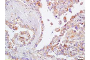 Formalin-fixed and paraffin embedded human lung carcinoma  labeled with Rabbit Anti-CD44 Polyclonal Antibody (ABIN669591) at 1:200 followed by conjugation to the secondary antibody and DAB staining
