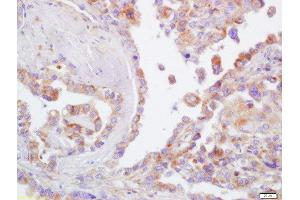 Formalin-fixed and paraffin embedded human lung carcinoma  labeled with Rabbit Anti-CD44 Polyclonal Antibody (ABIN669591) at 1:200 followed by conjugation to the secondary antibody and DAB staining (CD44 anticorps  (AA 701-742))