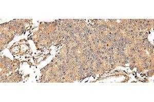 Immunohistochemistry of paraffin-embedded Human prostate cancer using ALDH3A2 Polyclonal Antibody at dilution of 1/20 (ALDH3A2 anticorps)