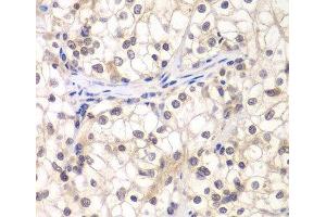 Immunohistochemistry of paraffin-embedded Human kidney cancer using USF1 Polyclonal Antibody at dilution of 1:200 (40x lens). (USF1 anticorps)
