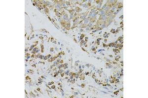 Immunohistochemistry of paraffin-embedded human lung cancer using IRF1 antibody. (IRF1 anticorps)