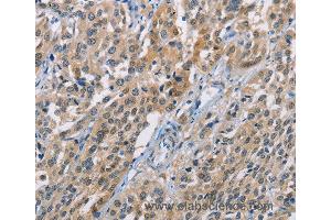 Immunohistochemistry of Human esophagus cancer using CBR1 Polyclonal Antibody at dilution of 1:40 (CBR1 anticorps)