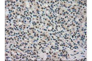 Immunohistochemical staining of paraffin-embedded Adenocarcinoma of colon tissue using anti-TRIB2mouse monoclonal antibody. (TRIB2 anticorps)
