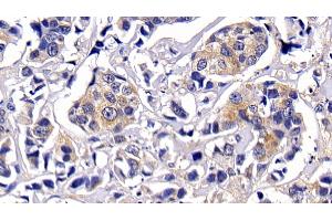 Detection of PKBa in Human Breast cancer Tissue using Polyclonal Antibody to Protein Kinase B Alpha (PKBa)