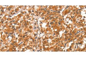 Immunohistochemistry of paraffin-embedded Human thyroid cancer tissue using DAB2IP Polyclonal Antibody at dilution 1:40