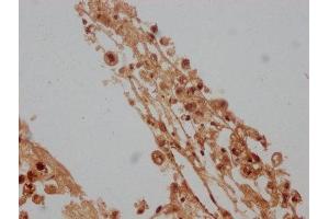 IHC image of ABIN7157890 diluted at 1:100 and staining in paraffin-embedded human melanoma cancer performed on a Leica BondTM system. (LAMb4 anticorps  (AA 1513-1761))