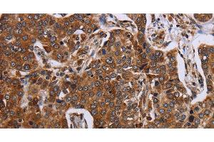 Immunohistochemistry of paraffin-embedded Human liver cancer using ACP6 Polyclonal Antibody at dilution of 1:30 (ACP6 anticorps)