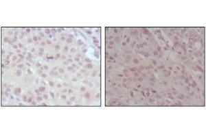 Immunohistochemical analysis of paraffin-embedded human lung cancer (left) and esophagus cancer (right), showing nuclear weak staining with DAB staining using MLL antibody. (MLL/KMT2A anticorps  (AA 3751-3968))