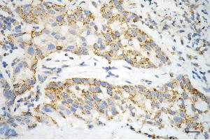 Immunohistochemistry was performed on paraffin-embedded human hepatocarcinoma using ACAT1 antibody (ABIN7797438), 1:200).