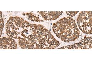 Immunohistochemistry of paraffin-embedded Human esophagus cancer tissue using CAD Polyclonal Antibody at dilution of 1:50(x200) (CAD anticorps)