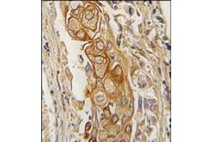 Formalin-fixed and paraffin-embedded human lung carcinoma tissue reacted with ACPP antibody (C-term), which was peroxidase-conjugated to the secondary antibody, followed by DAB staining. (ACPP anticorps  (C-Term))