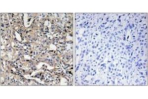 Immunohistochemistry analysis of paraffin-embedded human liver carcinoma, using BAX Antibody. (BAX anticorps  (AA 10-59))